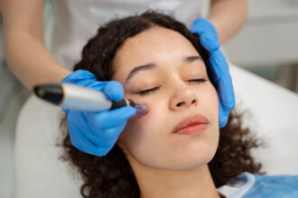 Microneedling for Acne Scars