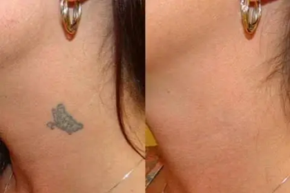 Tattoo removal laser