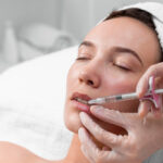 Microneedling for Acne Scar Treatment